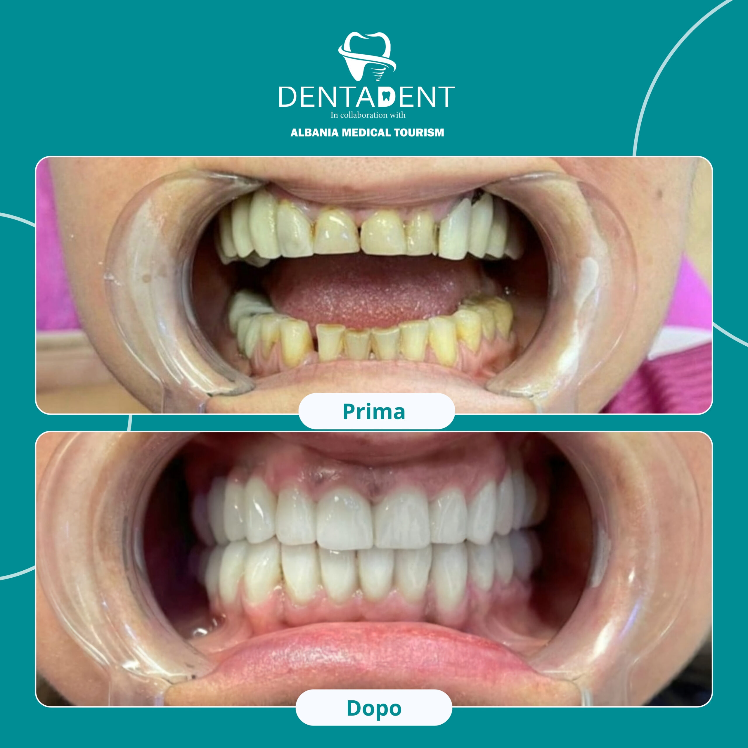 https://dentadent.al/wp-content/uploads/2025/01/Blue-and-Green-Gradient-Dental-Instagram-Post_20241120_110444_0000-scaled.jpg