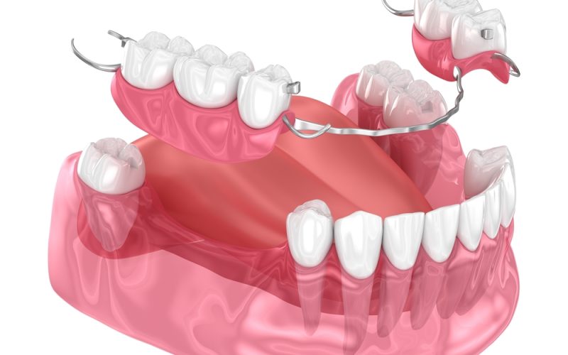 Removable,Partial,Denture,,Mandibular,Prosthesis.,Medically,Accurate,3d,Illustration,Of Removable,Partial,Denture,,Mandibular,Prosthesis.,Medically,Accurate,3d,Illustration,Of