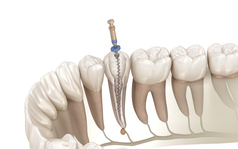 Endodontic,Root,Canal,Treatment,Process.,Medically,Accurate,Tooth,3d,Illustration. Endodontic,Root,Canal,Treatment,Process.,Medically,Accurate,Tooth,3d,Illustration.